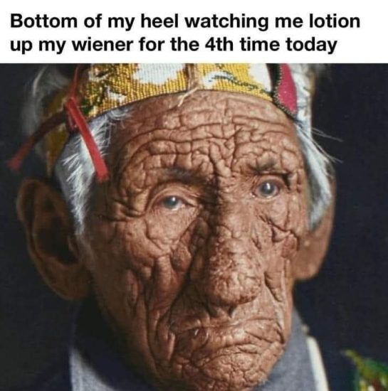 Cracked heel meme comparing foot dryness to frequent lotion use.