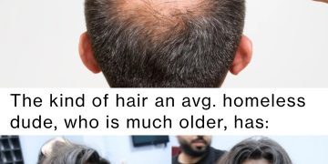 Two images comparing a balding head in 20s to a full-haired older person.