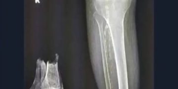 X-ray shows unexpected humor with a misplaced bone.
