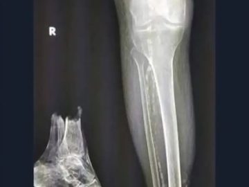 X-ray shows unexpected humor with a misplaced bone.