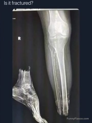 X-ray shows unexpected humor with a misplaced bone.