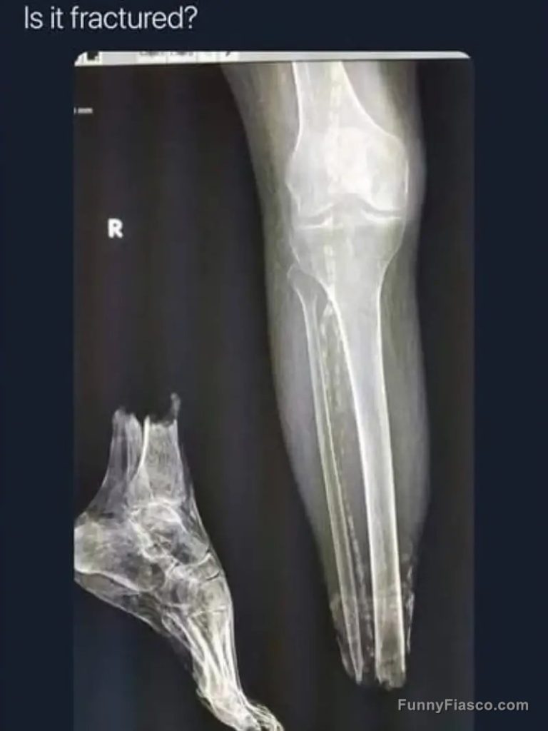 X-ray shows unexpected humor with a misplaced bone.