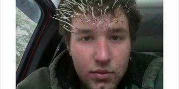Man with quills in face after looking into a noisy tree.